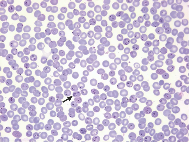 Purple-stained red blood cells, with an arrow pointing to a cell containing a malaria parasite