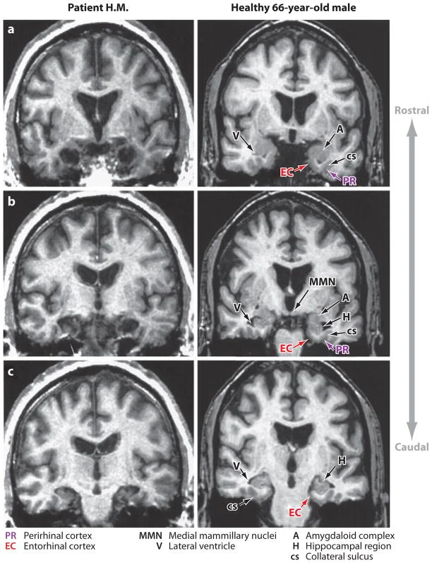 MRI of H.M.'s lesion (left) compared with a healthy brain (right), showing the bilateral removal of medial temporal structures including hippocampus, amygdala, and entorhinal cortex