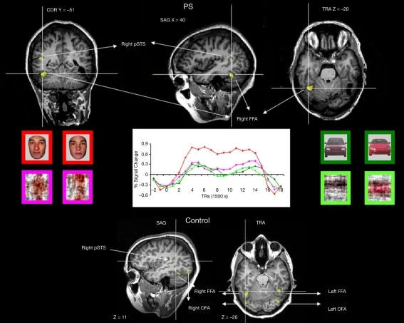 Three-node core face-processing network showing OFA in inferior occipital cortex, FFA in fusiform gyrus, and pSTS in superior temporal sulcus, with directional arrows