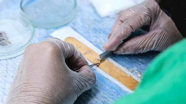 Gloved hands use forceps and a blade to prepare hair grafts on a wooden stick over a sterile blue drape