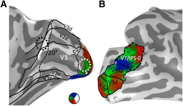 Pre- and post-resection fMRI face selectivity maps for Patient SP showing stable downstream face-selective responses after OFA removal