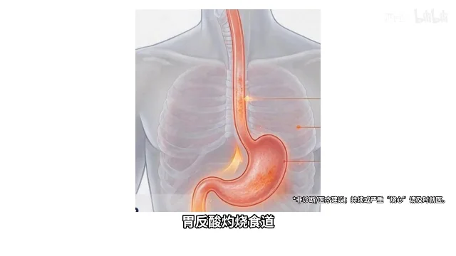 人体胸腔剖面示意图，橙色食道连到胃部，胃里一段箭头往上返，下方字幕写着「胃反酸灼烧食道」