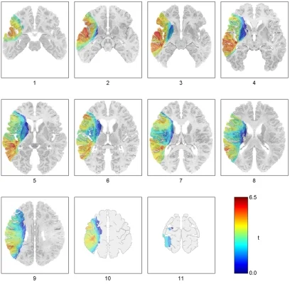 Lesion map of language comprehension regions