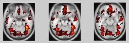 Probabilistic overlap map of faces > objects contrast across subjects, showing hotspot clusters