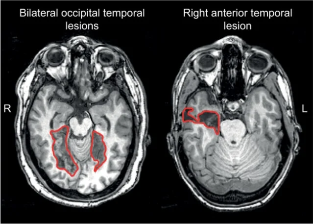 MRI scans showing two prosopagnosia subtypes: bilateral occipital-temporal lesions (left, apperceptive variant) and right anterior temporal lesion (right, associative variant), with lesion boundaries outlined in red