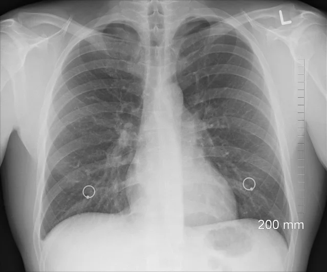 Frontal chest X-ray showing both lung fields; the left side displays opacification consistent with pleural fluid accumulation