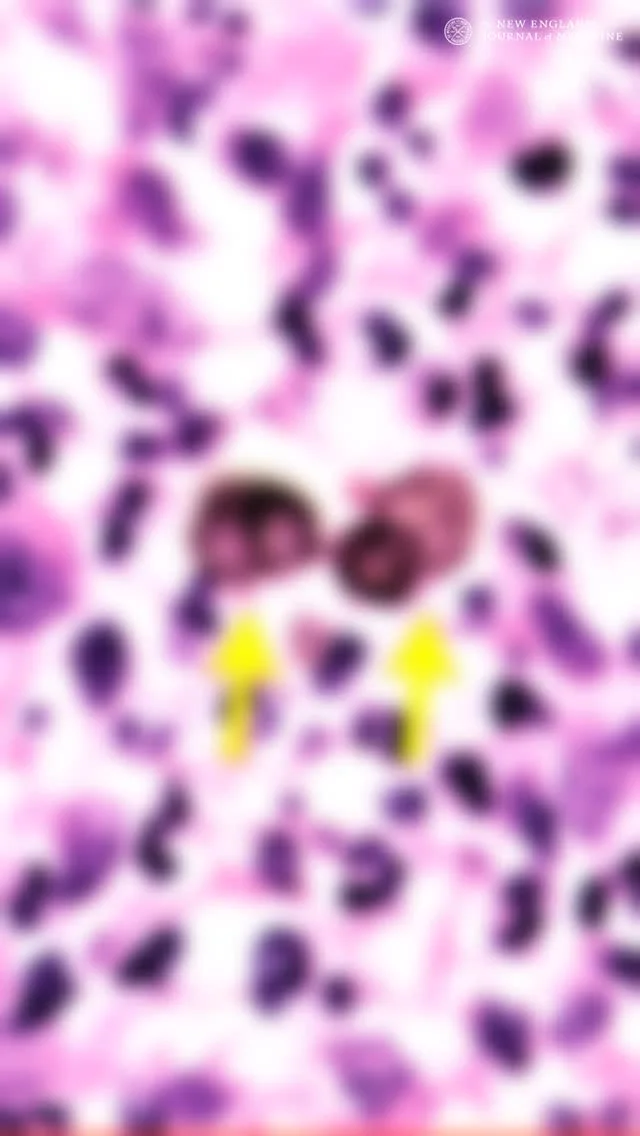 H&E-stained skin biopsy from a 38-year-old Honduran woman with a 9-year itchy abdominal lesion; yellow arrows mark two dark pigmented diagnostic structures consistent with a deep fungal or parasitic infection