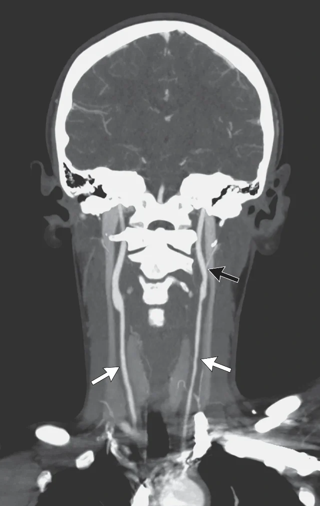 Coronal CT angiogram of the neck in a 14-year-old girl with Takayasu arteritis; three arrows (two white, one black) point to bilateral carotid arteries and the non-visualized left internal jugular vein, illustrating large-vessel vasculitis with abnormal vessel opacification
