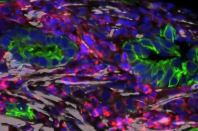 Metastatic pancreatic tumor microenvironment: cancer cells (green) surrounded by activated fibroblasts (gray) in an immunosuppressive milieu (red)