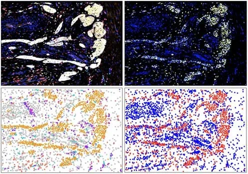 Dana-Farber composite panel: tumor microenvironment with VDR expression (upper right), digital image analysis identifying cell types by protein markers (lower left), and VDR-responsive (red) vs. non-responsive (blue) cells (lower right)