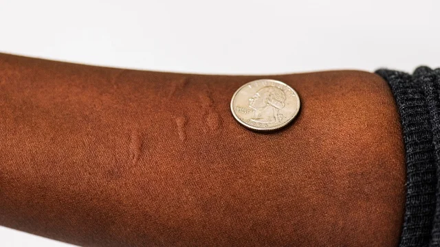 Multiple mosquito bites on a forearm