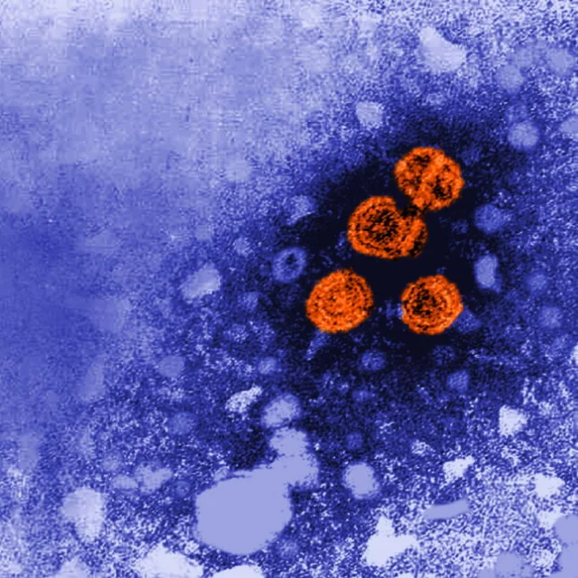 Transmission electron micrograph revealing hepatitis B virus particles (orange)