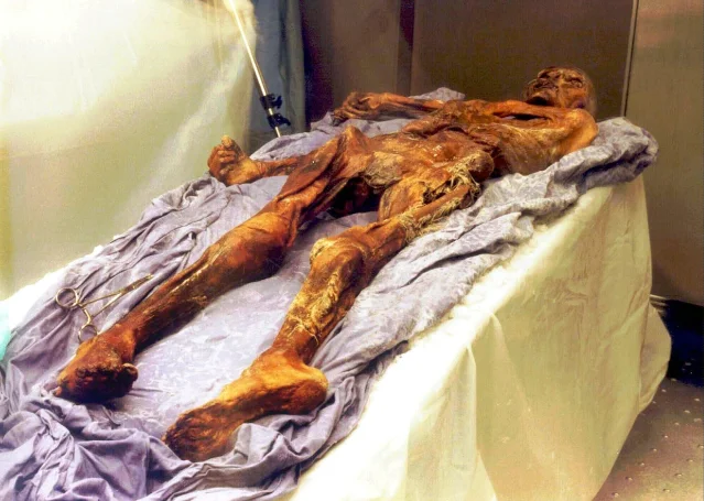 Ötzi the Iceman laid out on a surgical table under laboratory lighting, 1991