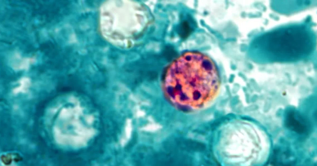 Cyclospora widens across 31 states