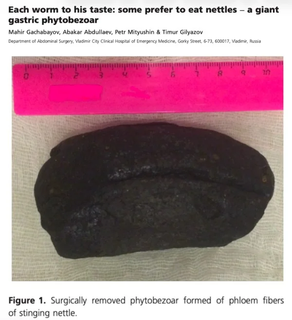 A large dark-brown fibrous mass — the surgically removed nettle phytobezoar — placed next to a pink centimeter ruler, showing it exceeds 10 cm