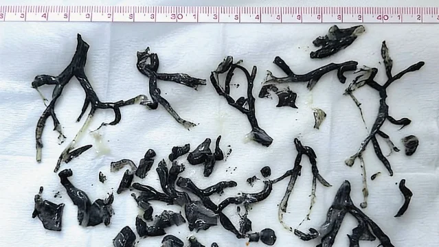 Bronchial cast specimen with a measuring tape showing scrambled number sequence after AI manipulation