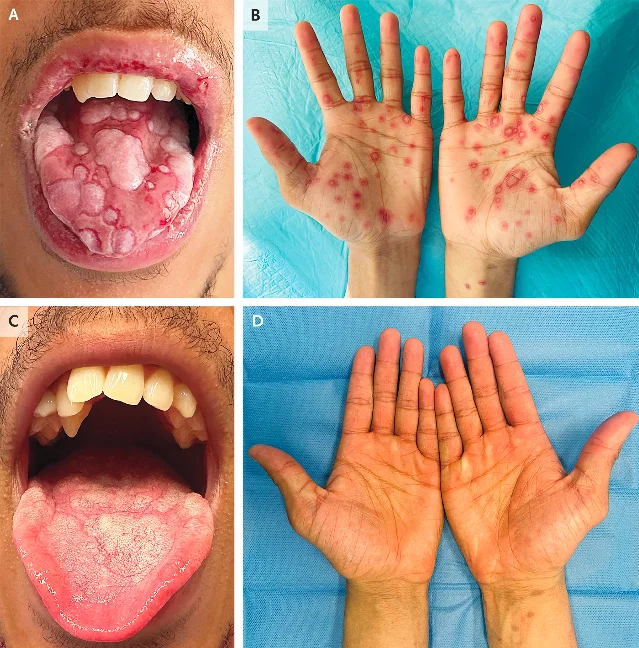 Four-panel clinical composite for erythema multiforme: panels A and B show pre-treatment oral cavity with extensive gray-white ulcerative erosions covering the tongue and hemorrhagic lip erosions, and bilateral palms with multiple targetoid erythematous ring lesions; panels C and D show complete resolution after treatment — clean oral mucosa and clear palms