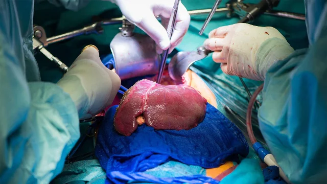 Operating room scene during liver transplant surgery, surgeons in sterile gowns around a patient